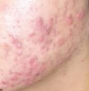 acne on face
